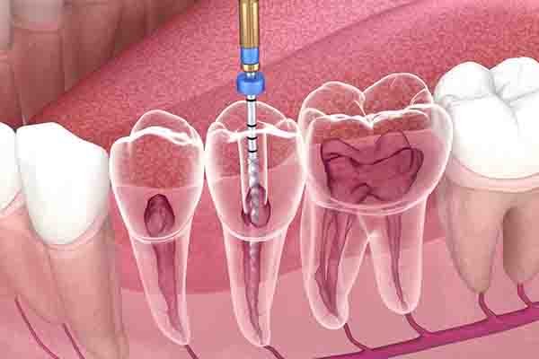 Endodoncia Avanzada