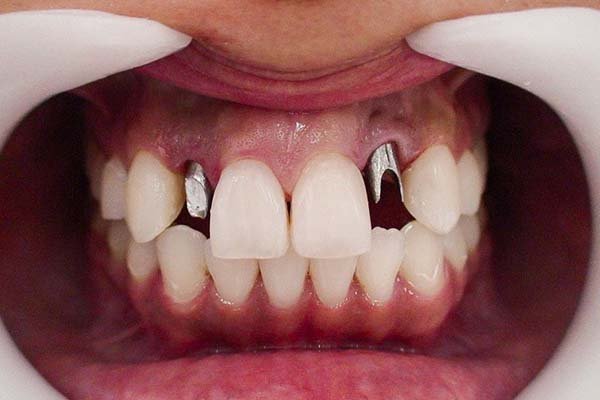Implantología Oral